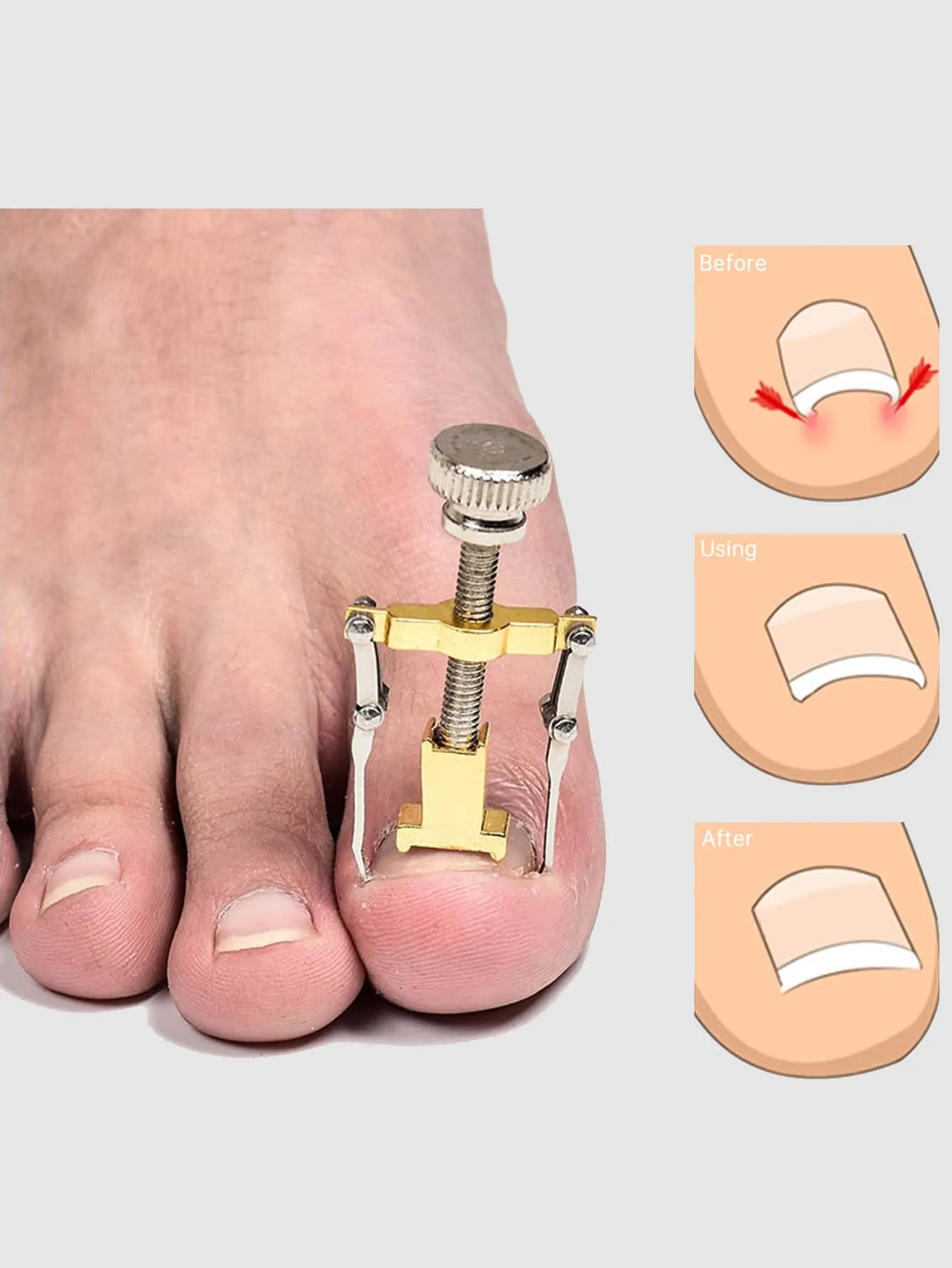 1pc Metal Ingrown Toenail Corrector